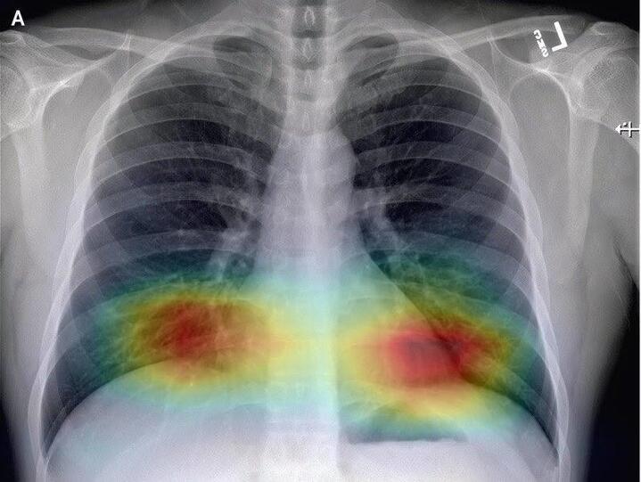 Рентгенограмма (два снимка) грудной клетки, 19 января 2020 г. (4-й день болезни).  Признаки воспалительного процесса